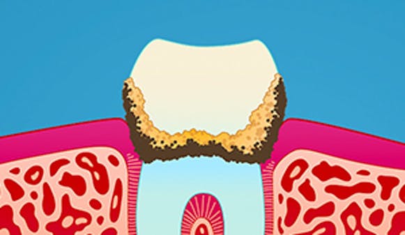 Hva_er_tannstein_w300__480821cba94b4a507b5abfd0cfdf90c9