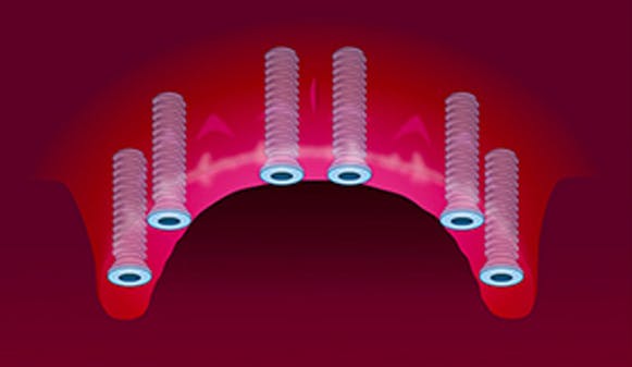 Implantat_hel_kjeve_thumbnail_w300__c0d0fbf301f3a14c1a596f24d63c9160