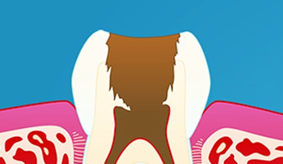 Rotfylling_w300__3d992cbbb13126ef4081c04aa2b8e70a