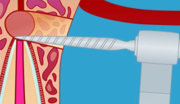 Rotspissamputasjon-_w300__d6e5ad854dad6e4d97b9dd51cd159470