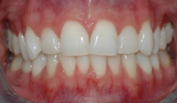 Tannbleking_w300__670b706bcfb1e7d3b434aca278397576