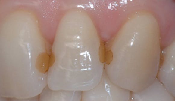 Utskifting_av_synlige_fyllinger_w300__e2d9398828c6eb18eda1eee4d041512e