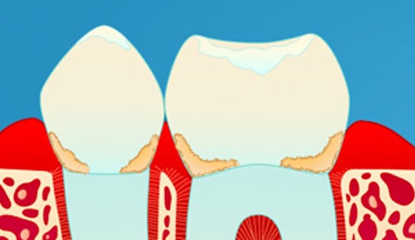 gingivitt_w300__0efa8298b53c4c1e45accc65c2aa437f